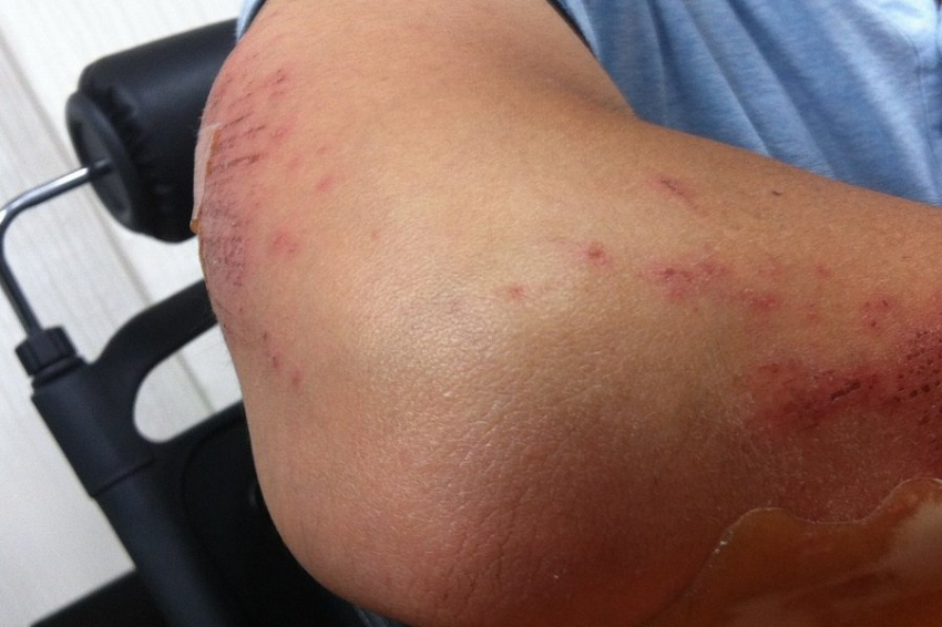 В Перми разработали инновационную противоожоговую мазь из человеческой крови